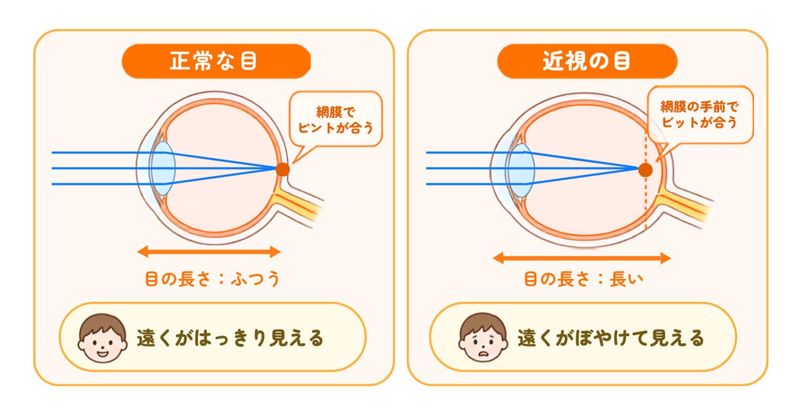なぜ近視になるの？